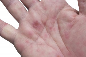 Hand, foot, and mouth disease